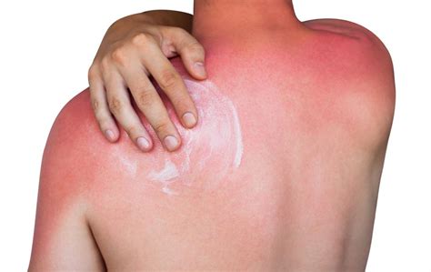 What is a sunburn?